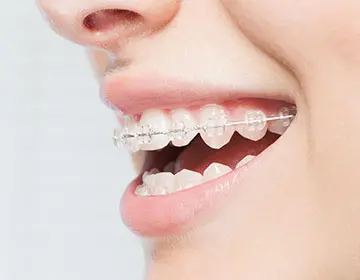 <br />
<b>Warning</b>:  Undefined variable $case_labels in <b>/home/wp874732/shidendori-orthodontics.com/public_html/wp_ssk/wp-content/themes/wp_ssk/content-archive-case.php</b> on line <b>102</b><br />
<br />
<b>Warning</b>:  Trying to access array offset on value of type null in <b>/home/wp874732/shidendori-orthodontics.com/public_html/wp_ssk/wp-content/themes/wp_ssk/content-archive-case.php</b> on line <b>102</b><br />
の治療前